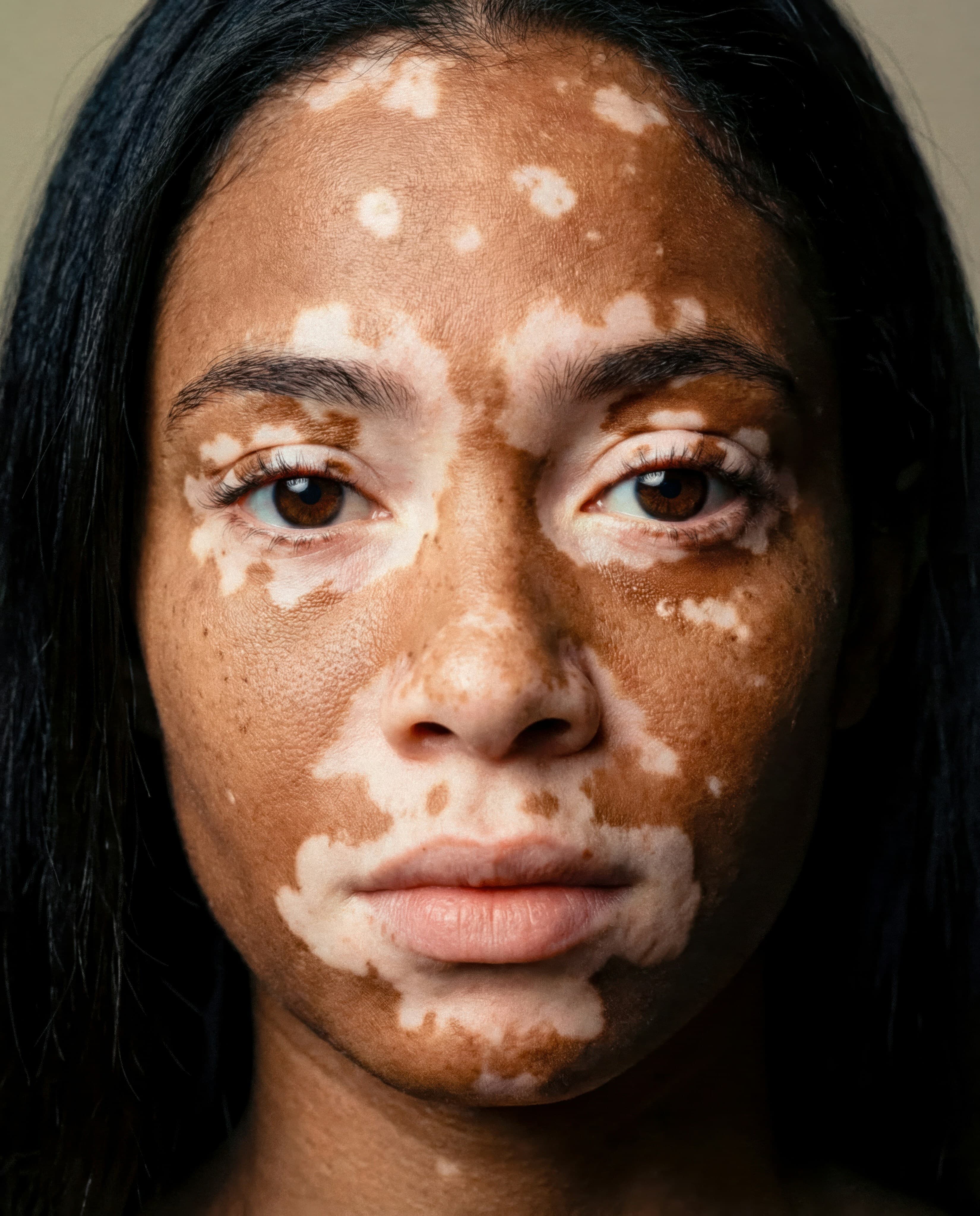 Close up on a girl's face showing her vitiligo